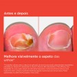 ISDIN Si-Nails MicoXpert MD Tratamento Onicomicose